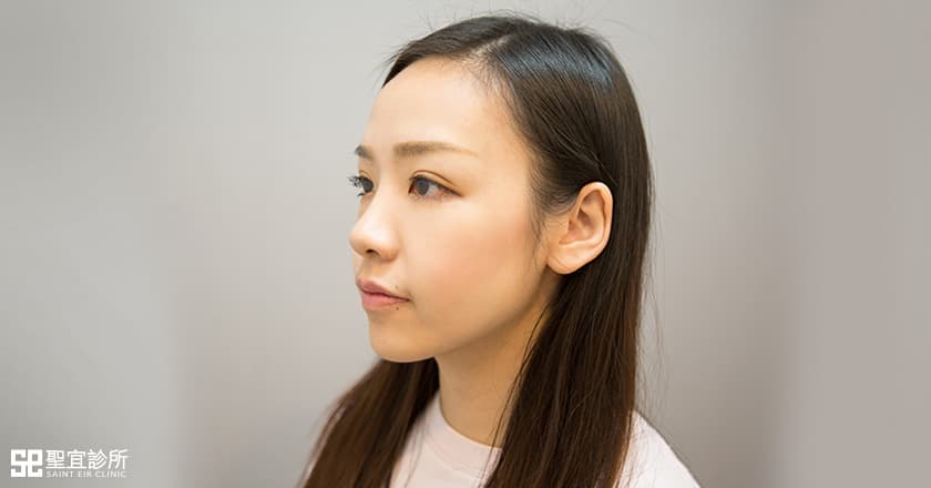 雙眼皮手術