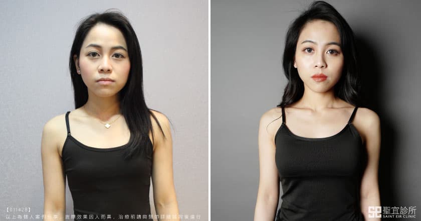 女模詹容魔滴隆乳術前術後