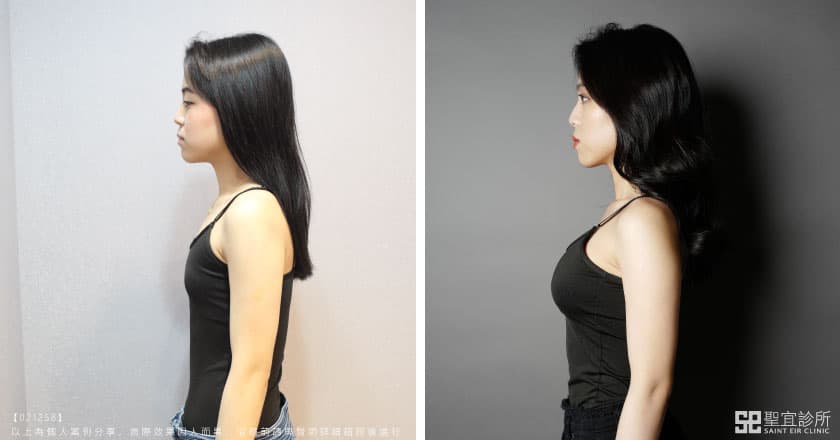 女模詹容魔滴隆乳術前術後