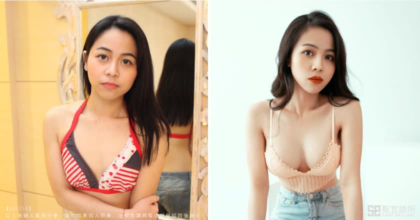 女模詹容魔滴隆乳術前術後