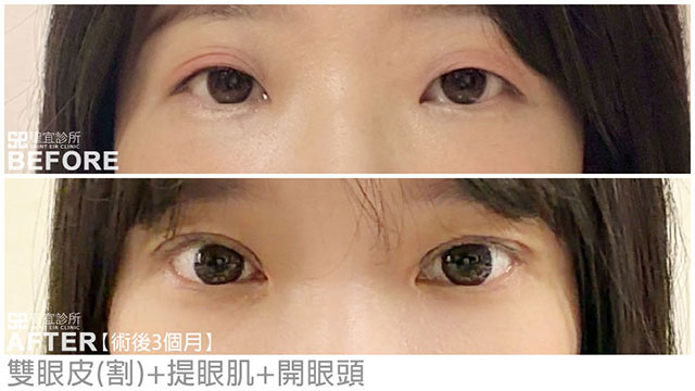 雙眼皮(割)+提眼肌+開眼頭．dr劉淳熙