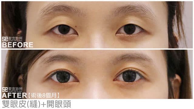 雙眼皮(縫)+開眼頭．dr倪宗聖