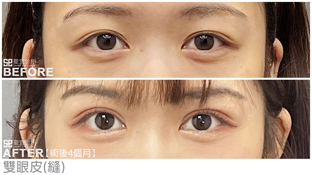 雙眼皮(縫)．dr解佳霖