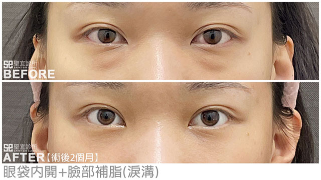 除眼袋(內開)+臉部補脂(淚溝)．dr劉淳熙