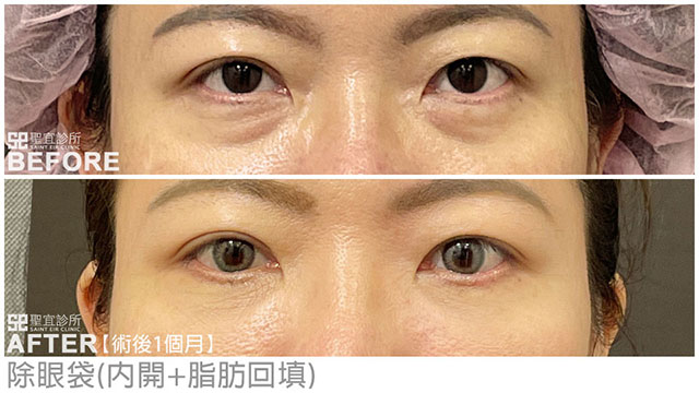 除眼袋(內開+脂肪回填．dr楊舒鈞