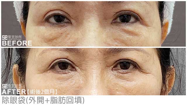 除眼袋(外開+脂肪回填)．dr解佳霖