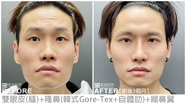 雙眼皮(縫)+隆鼻(韓式Gore-Tex+自體肋)+縮鼻翼．dr倪宗聖