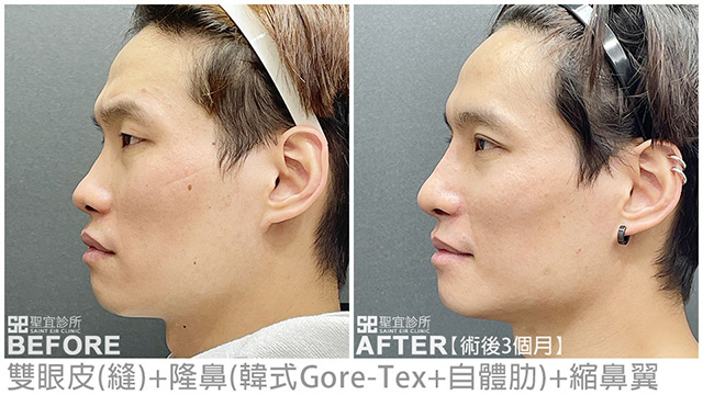 雙眼皮(縫)+隆鼻(韓式Gore-Tex+自體肋)+縮鼻翼．dr倪宗聖
