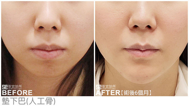 墊下巴(人工骨)
