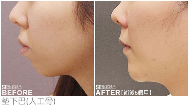墊下巴(人工骨)．dr胡岱霖