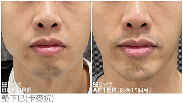 墊下巴(卡麥拉)．dr倪宗聖