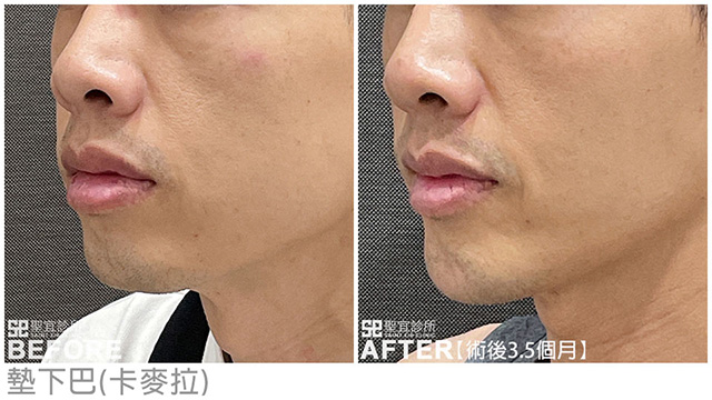 墊下巴(卡麥拉)．dr倪宗聖