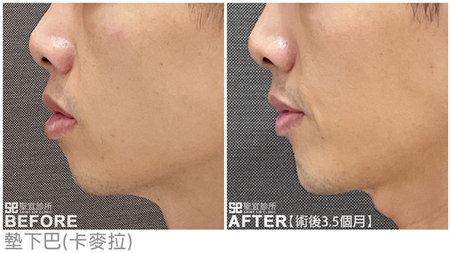墊下巴(卡麥拉)．dr倪宗聖