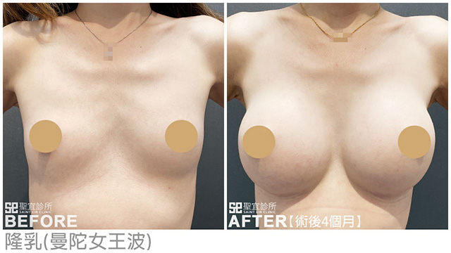 隆乳(曼陀女王波)