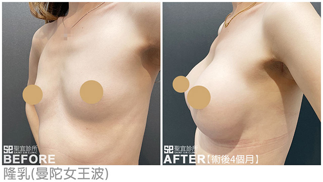 隆乳(曼陀女王波)