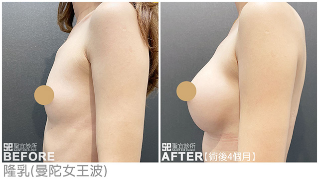 隆乳(曼陀女王波)