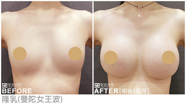 隆乳(曼陀女王波)