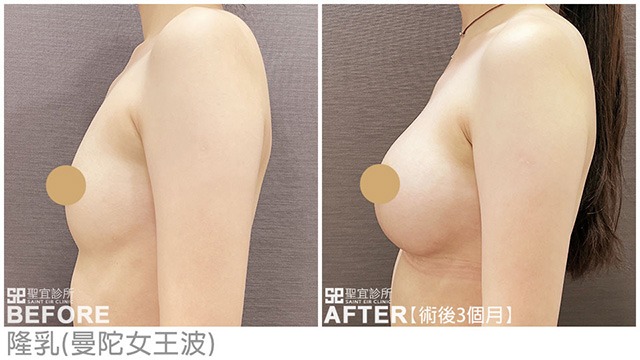 隆乳(曼陀女王波)