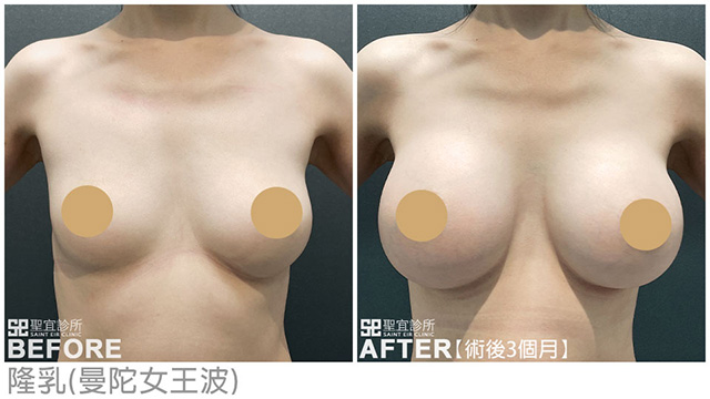 隆乳(曼陀女王波)