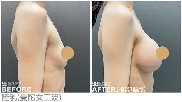 隆乳(曼陀女王波)