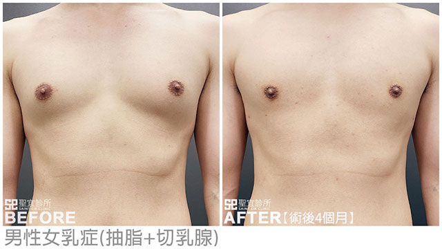 男性女乳症(抽脂+切乳腺)