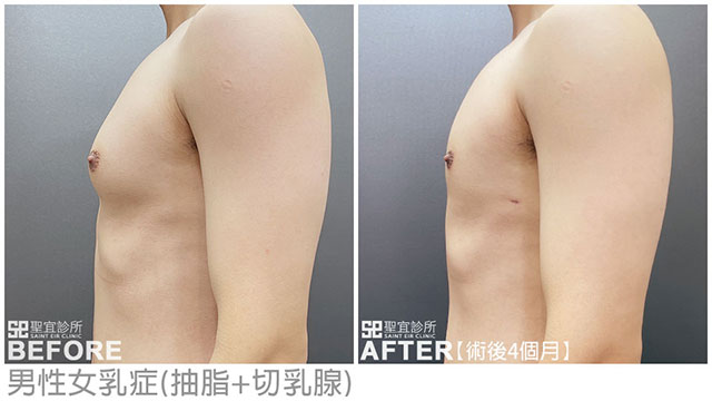 男性女乳症(抽脂+切乳腺)