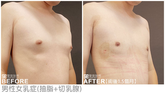 男性女乳症(抽脂+切乳腺)．dr劉厚耕