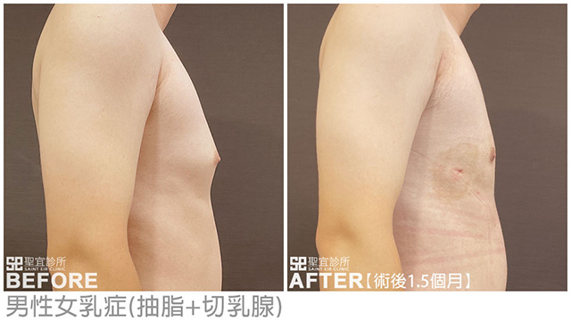男性女乳症(抽脂+切乳腺)．dr劉厚耕