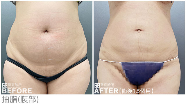 抽脂(腹部)