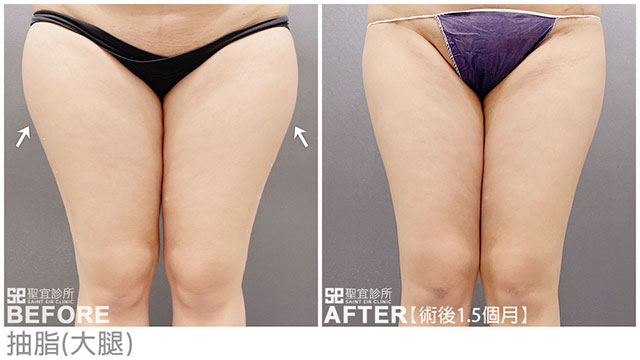 抽脂(大腿)