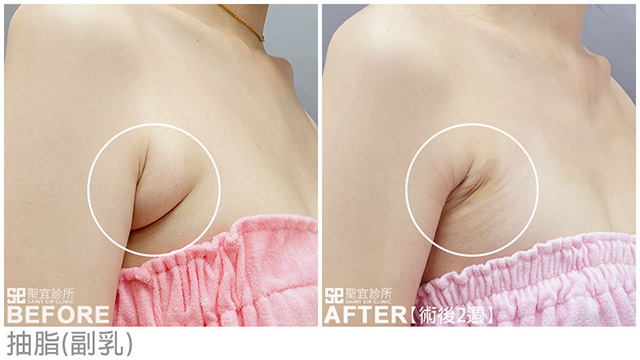 抽脂(副乳)