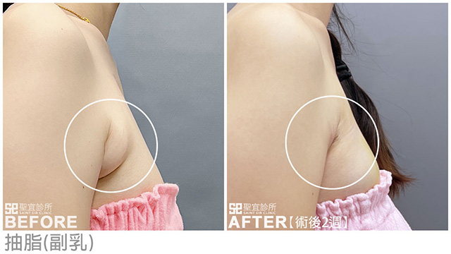 抽脂(副乳)