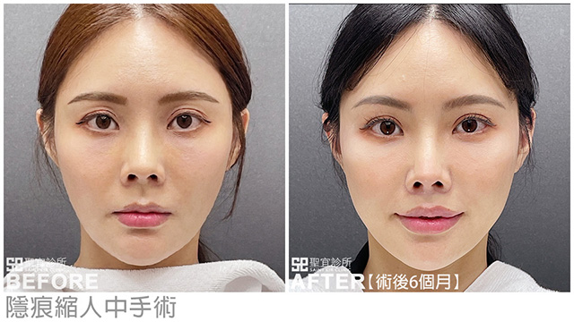 隱痕縮人中．dr倪宗聖