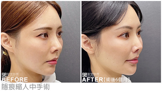 隱痕縮人中．dr倪宗聖