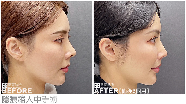 隱痕縮人中．dr倪宗聖