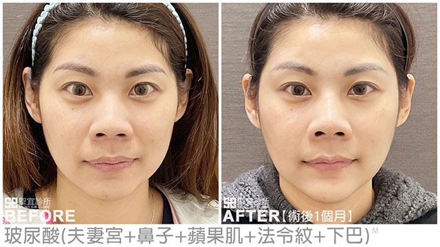 玻尿酸(夫妻宮、鼻子、蘋果肌、法令紋、下巴)