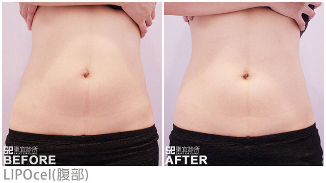 LIPOcel立倍塑(腹部)