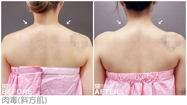 肉毒(斜方肌)．dr蘇聖傑