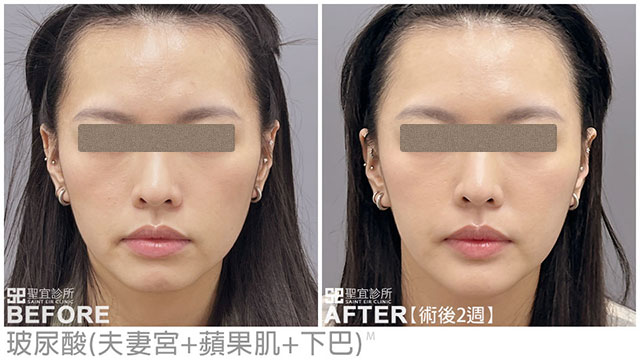 玻尿酸(夫妻宮+蘋果肌+下巴)．dr龍勤莉