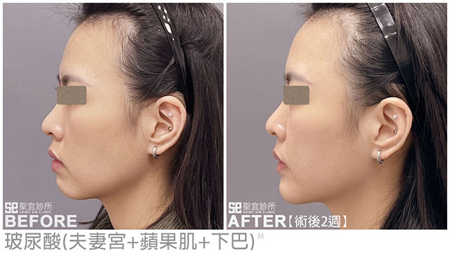 玻尿酸(夫妻宮+蘋果肌+下巴)．dr龍勤莉