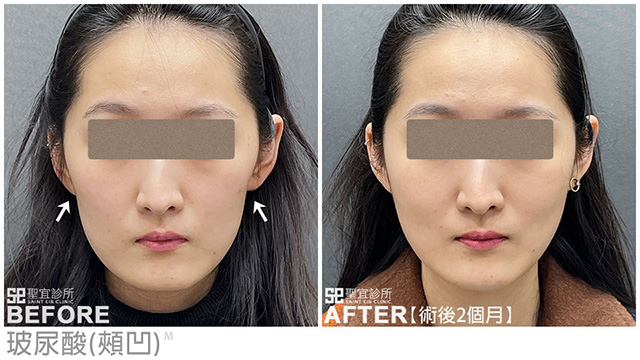 玻尿酸(頰凹)．dr林雨晴