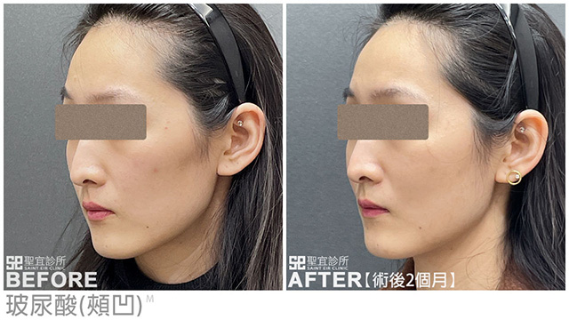 玻尿酸(頰凹)．dr林雨晴