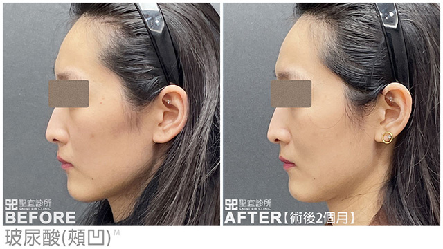 玻尿酸(頰凹)．dr林雨晴