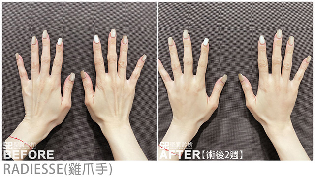 RADIESSE(雞爪手)．dr林庭伊