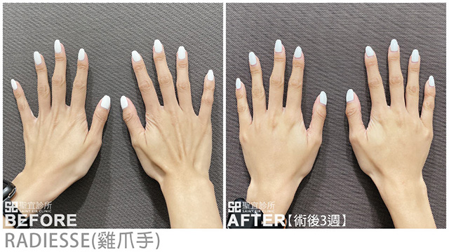 RADIESSE(雞爪手)．dr林雨晴