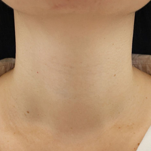 PROFHILO逆時針(頸紋）After