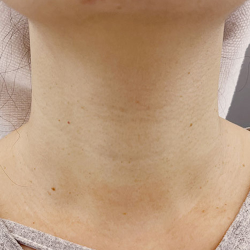 PROFHILO逆時針(頸紋）Before