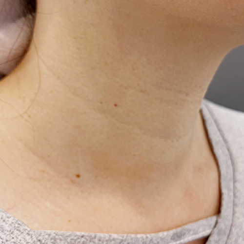 PROFHILO逆時針｜臨床案例（臉部）Before