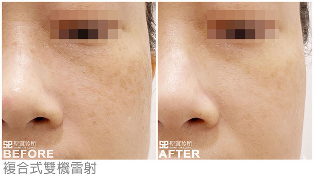 複合式雙機雷射