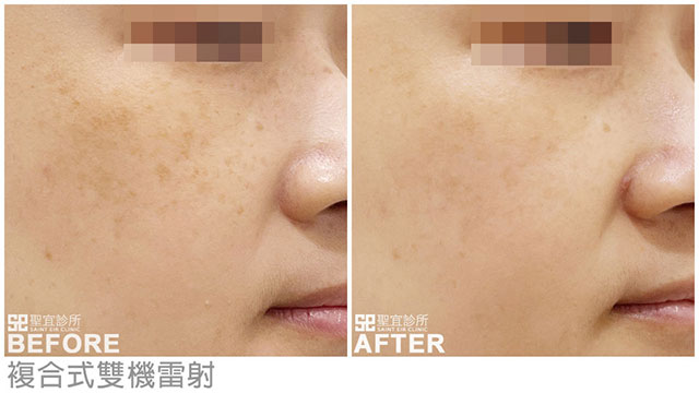 複合式雙機雷射